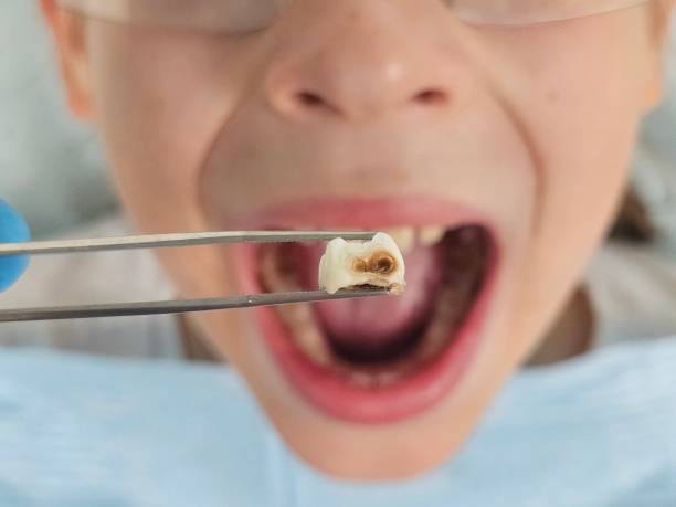 Best Emergency Dental Care for Broken or Chipped Teeth in Glen Allen, VA